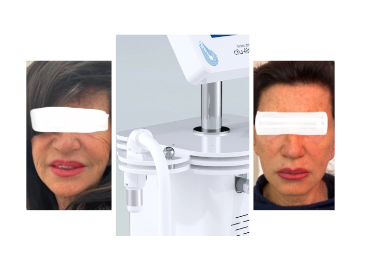 Hautverjüngerung Wien